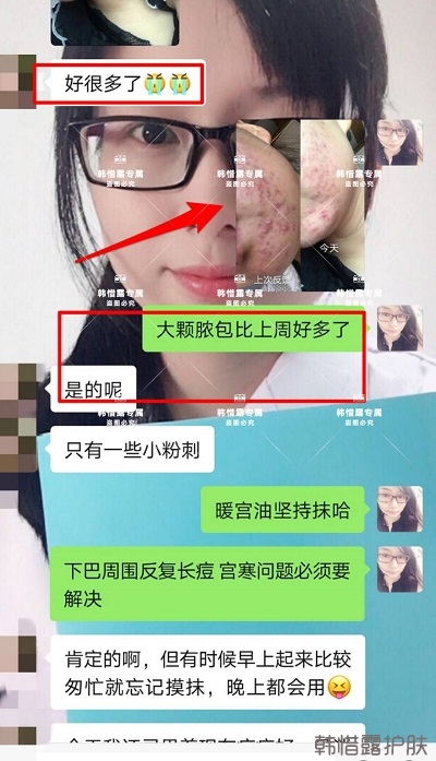 脸上长痘如何消除，下巴长痘案例反馈，脓包痘痘好多了