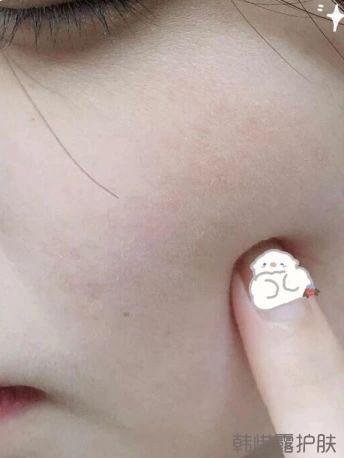 反复长痘这么多年，你需要找准痘因？