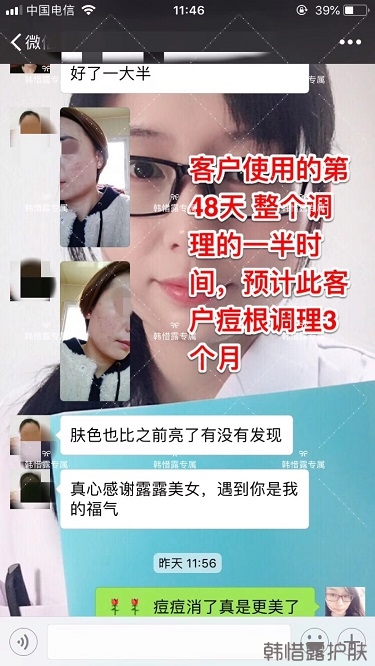 脸上一直长痘痘脓包怎么解决？痘痘开始消了，更美丽！
