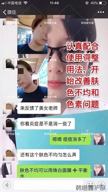 脸上一直长痘痘脓包怎么解决？痘痘开始消了，更美丽！