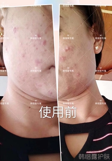 脸上一直长痘痘脓包怎么解决？痘痘开始消了，更美丽！