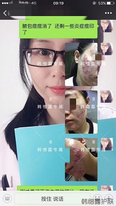 脓包痘痘好了，从惨不忍睹到变美变漂亮