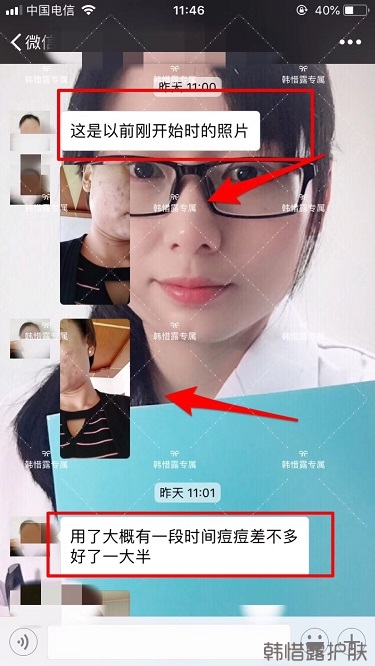 脸上一直长痘痘脓包怎么解决？痘痘开始消了，更美丽！