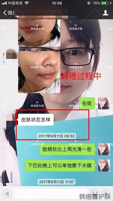 粉刺密密麻麻，试过很多方法无果后找韩惜露老师轻松去掉粉刺！