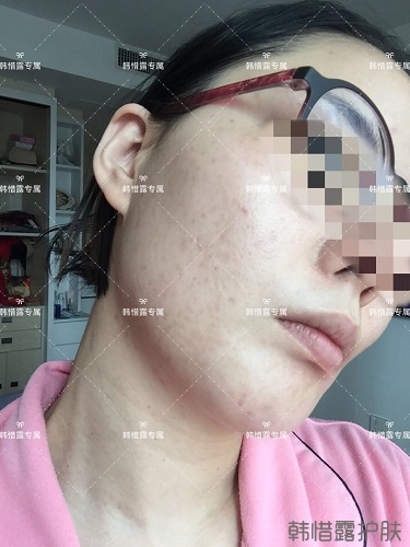 粉刺痘痘，痘印都没了，宝妈重回颜值巅峰！