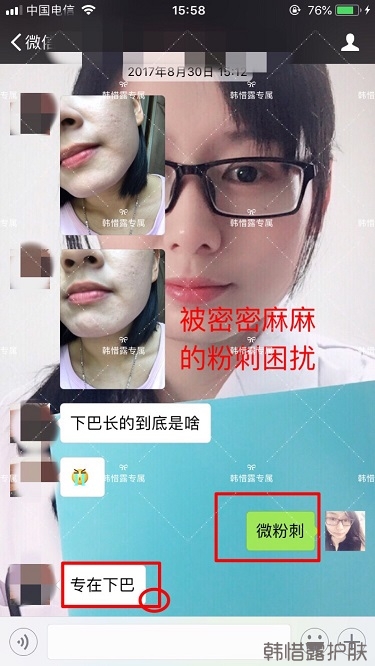 粉刺密密麻麻，试过很多方法无果后找韩惜露老师轻松去掉粉刺！