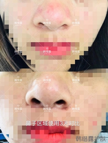 鼻子发红长痘痘消了，皮肤吸收好就是任性！
