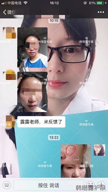 堵塞毛孔疏通后,痘痘比上周消下去不少!