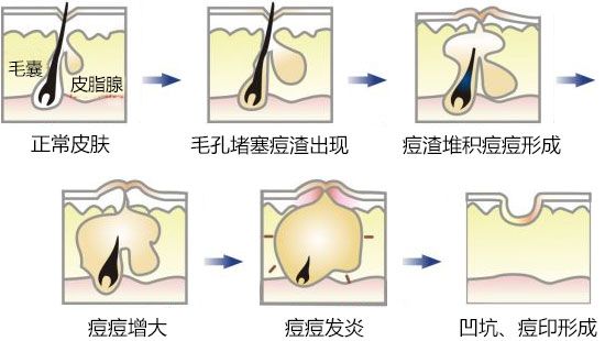 有去痘印最有效的方法吗？