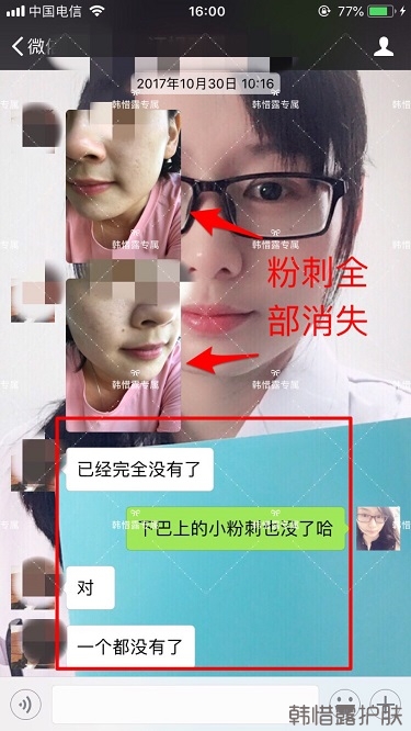 粉刺密密麻麻，试过很多方法无果后找韩惜露老师轻松去掉粉刺！