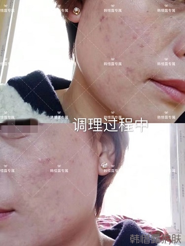 脸上一直长痘痘脓包怎么解决？痘痘开始消了，更美丽！