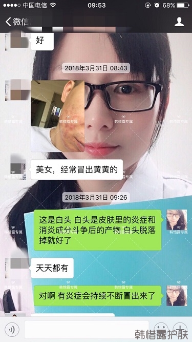 脓包结节发硬痘痘全消了，帅哥开心的来反馈了！