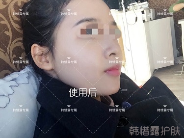 痘花妹变无暇美女